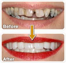 Smile Designing Teeth  Shape in Mumbai